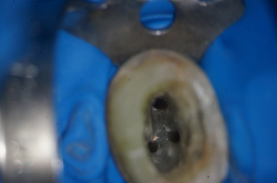 стоматологический микроскоп извлечение штифта