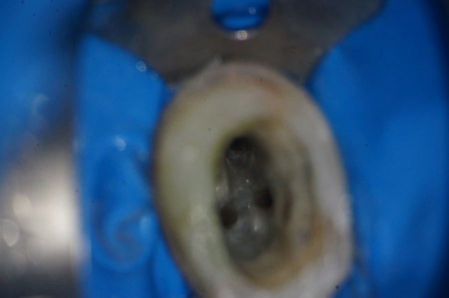 стоматологический микроскоп извлечение штифта киров