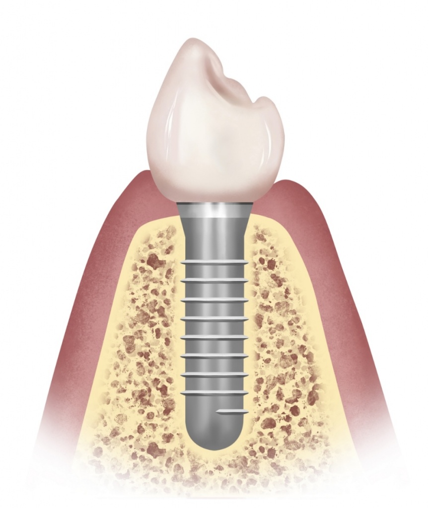 Этапы установки зубных протезов