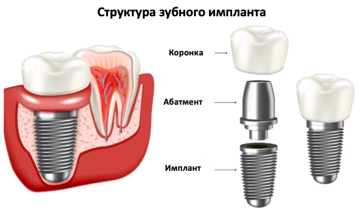 Структура зубного импланта