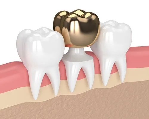 Зубные коронки из золота