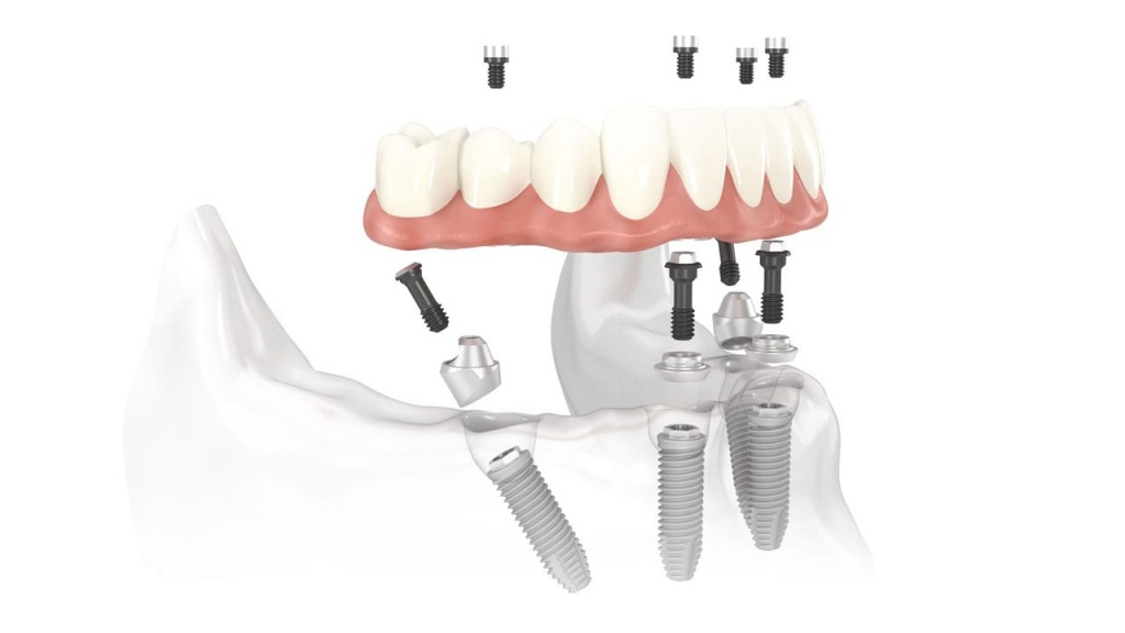 Зубной имплант All-on-4
