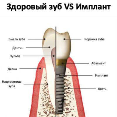 Здоровый зуб и имплант