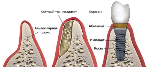 Костная пластика для зубных имплантатов